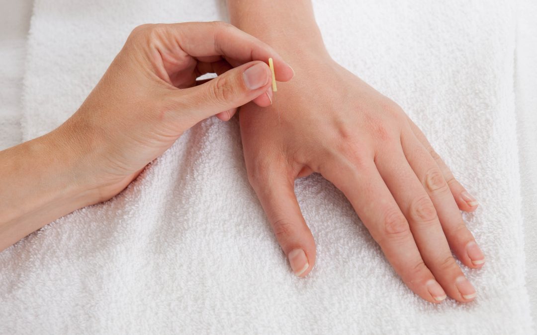 What is the Difference Between Dry Needling & Acupuncture?