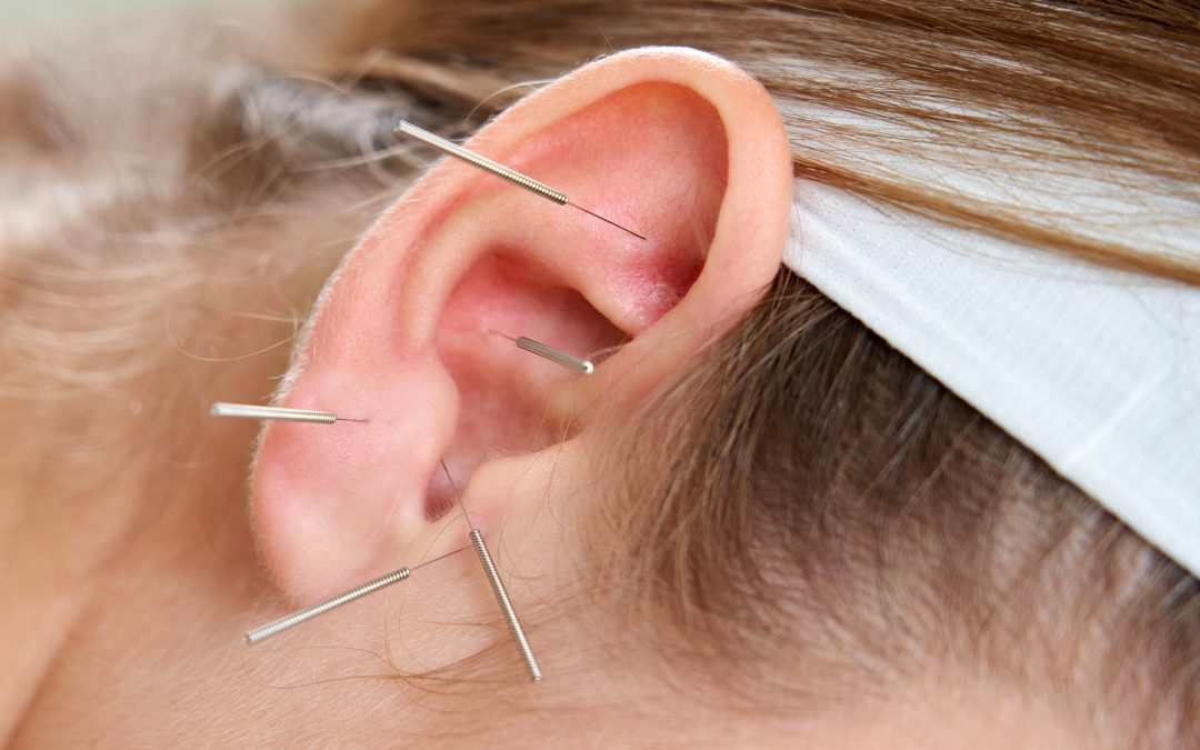 How Often Should You Do Acupuncture?