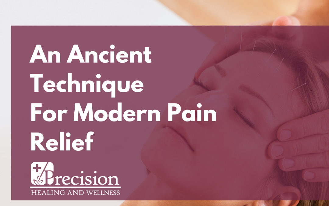 Exploring Acupuncture for Migraines: Ancient Healing for Modern Headache Relief
