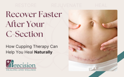 C-Section Recovery in Brookfield, WI: How Cupping Therapy Can Help Heal Your Scar and Reduce Pain